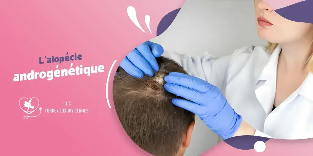 L'alopécie androgénétique