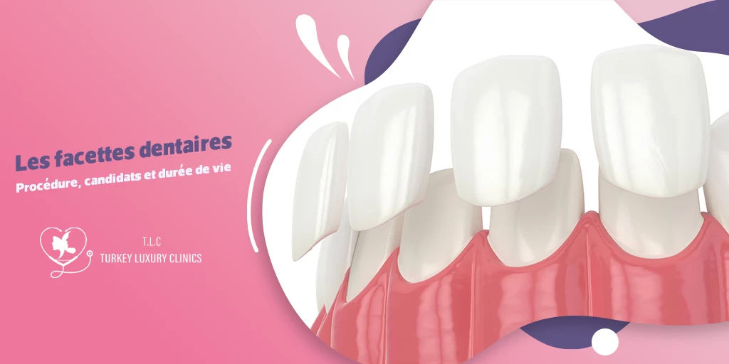 Les facettes dentaires : Procédure, candidats et durée de vie