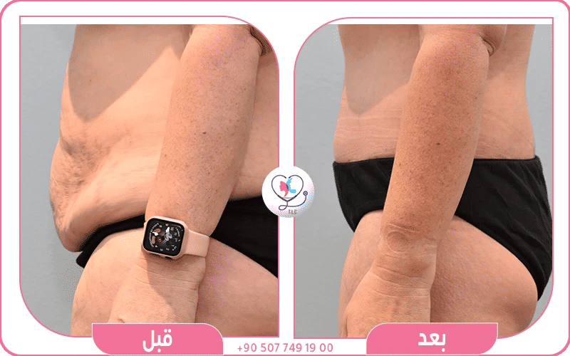 عملية نحت الجسم قبل وبعد