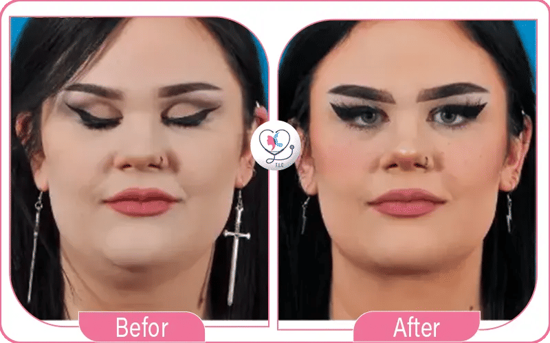 صور قبل وبعد إزالة اللغلوغ بالليزر