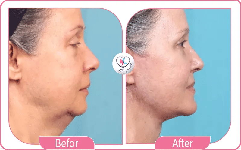 Results After Mini Neck Lift