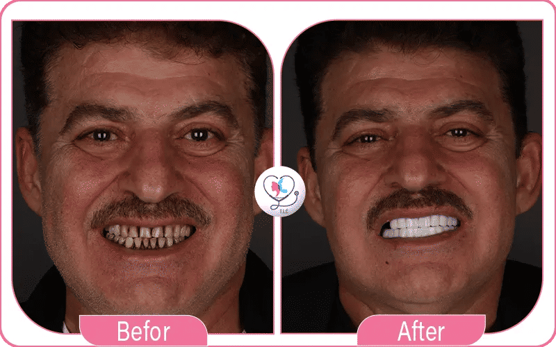 Emax Veneers in Turkey Before and After