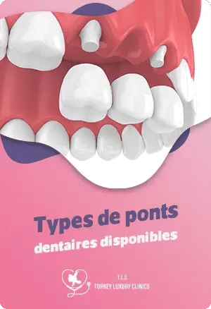 Types de ponts dentaires disponiblesfeatured image