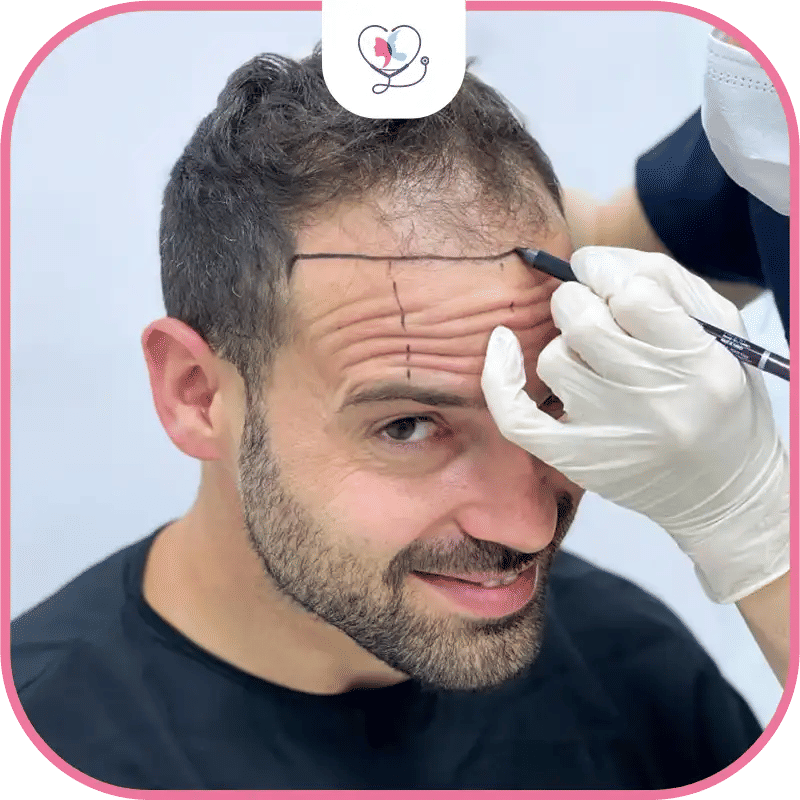 All you Need to Know About Receding Hairline