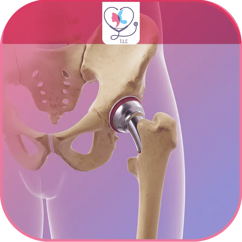 تجربتي مع عملية استبدال مفصل الورك