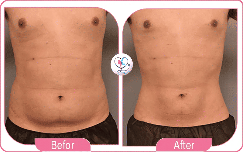 شفط دهون الصدر: النتائج بالصور مع الأسعار -1772049031419