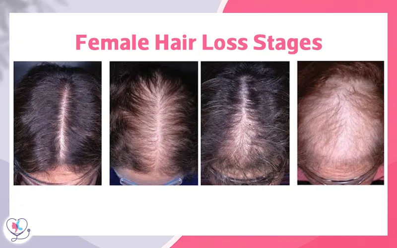 Female Hair Loss Stages
