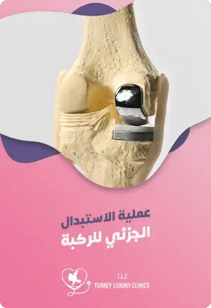 ماهي عملية الاستبدال الجزئي للركبة في تركيا؟featured image