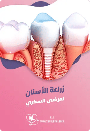 زراعة الأسنان لمرضى السكري: الإرشادات والتوصياتfeatured image