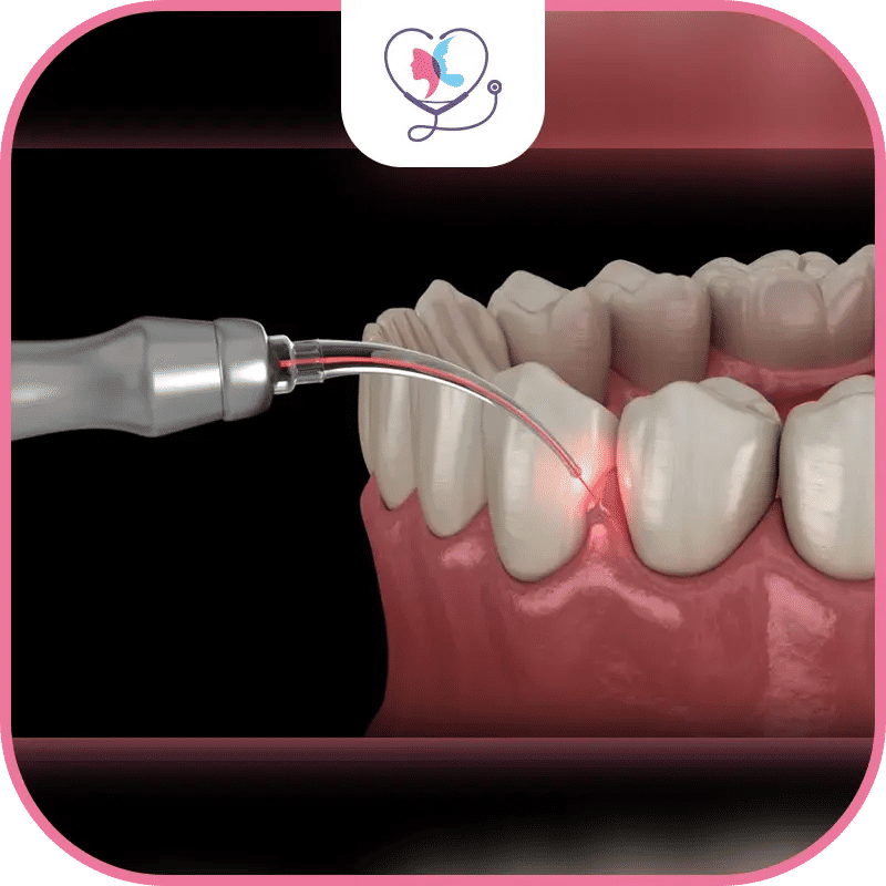 جراحة اللثة في تركيا