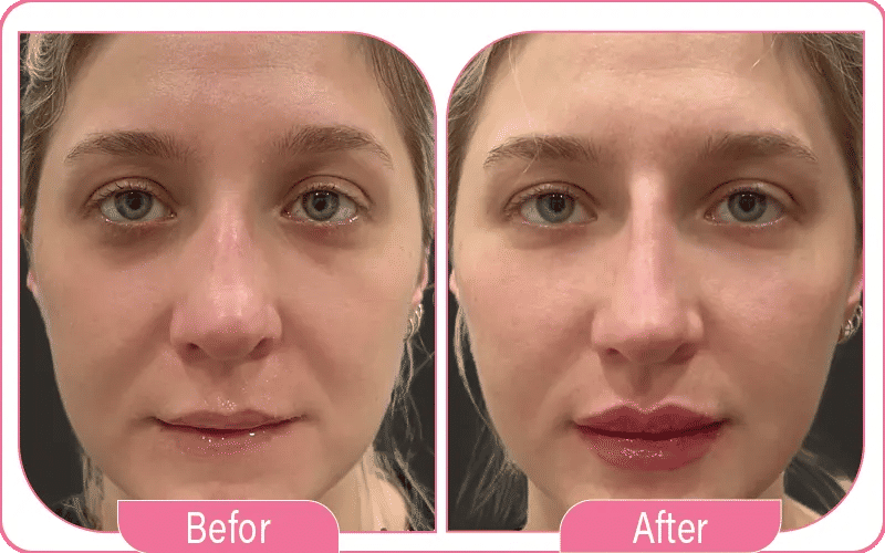 What to Expect After Lip Filler