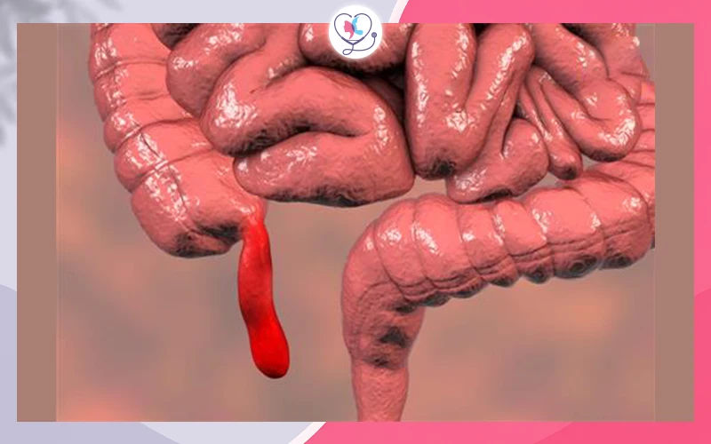 التهاب الزائدة الدودية