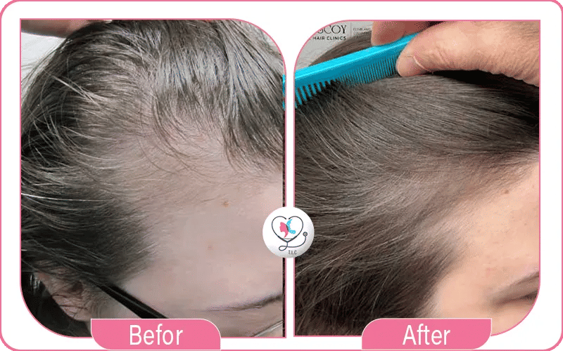 تجربتي مع الخلايا الجذعية للشعر في تركيا لاكشري كلينك تجربتي مع الخلايا الجذعية للشعر في تركيا لاكشري كلينك