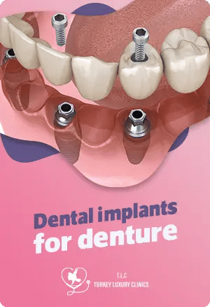Dental Implants for Denture Stability: Enjoying a Secure and Comfortable Smile
