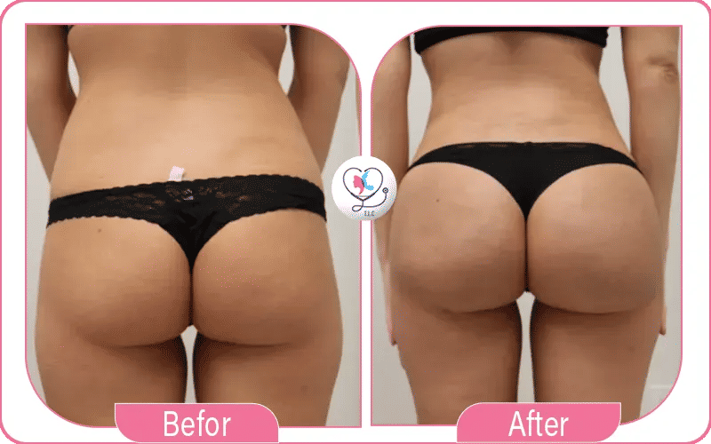 النحافة مع المؤخرة المتناسقة