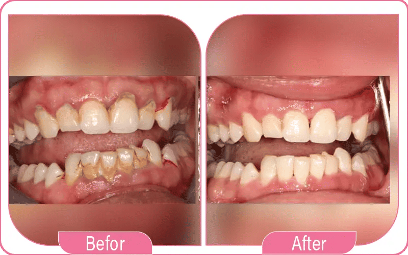 Surfaçage radiculaire vs détartrage : Quelle est la vraie différence ?