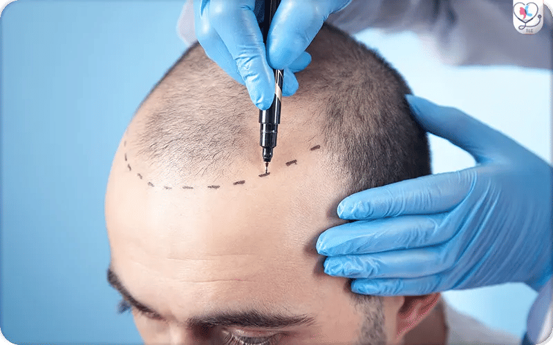 لماذا تُعَدّ تركيا الخيار الأمثل لزراعة الشعر؟