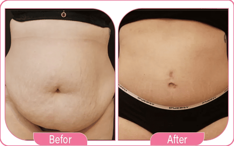 Résultats avant/après : à quoi s’attendre ?