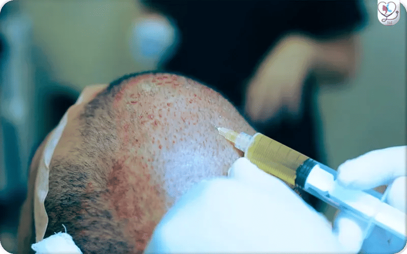 سعر جلسة الخلايا الجذعية للشعر