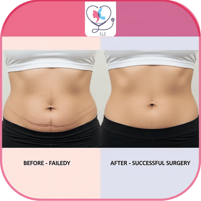 علامات فشل عملية شد البطن