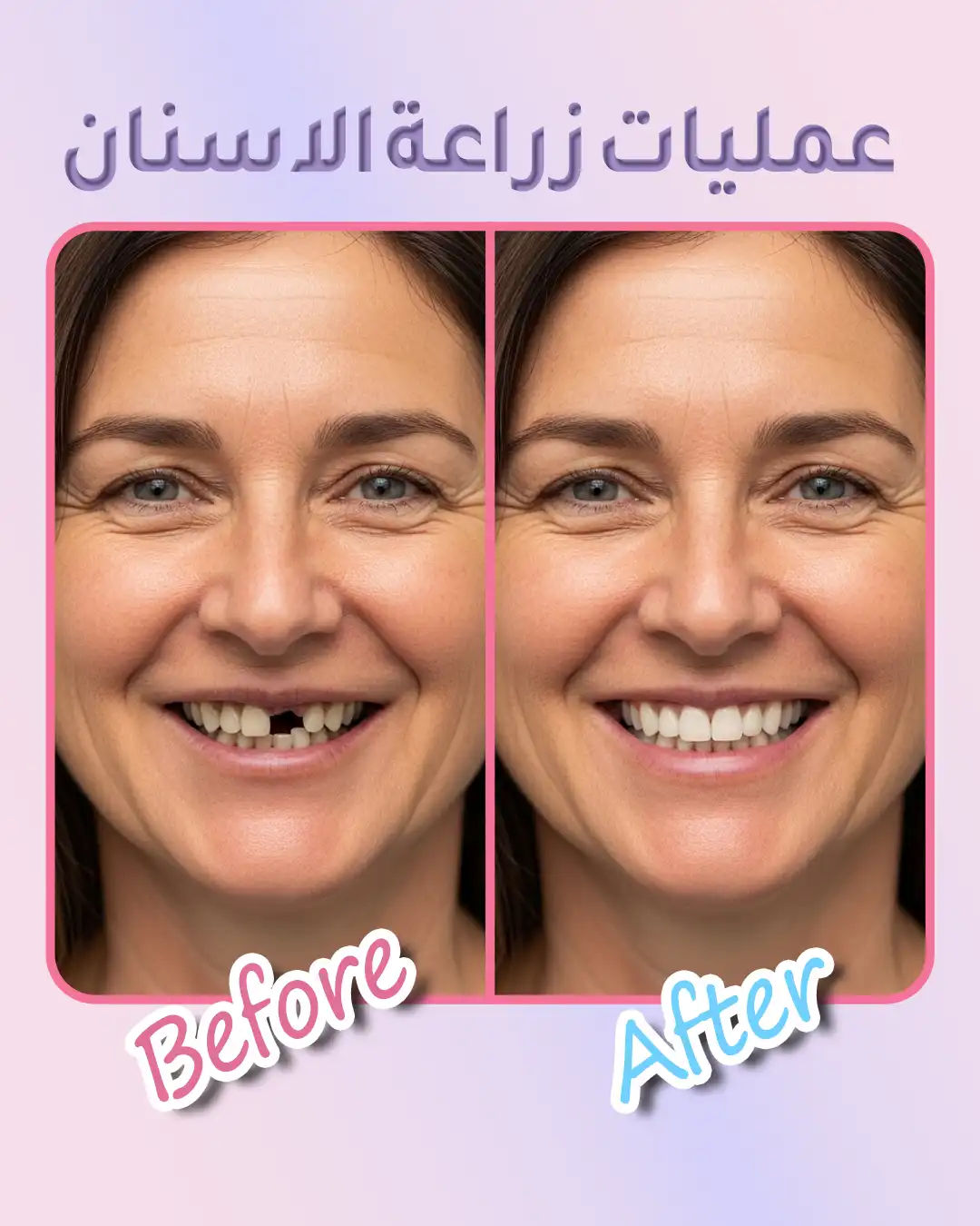 تجربتي مع زراعة الأسنان في تركيا