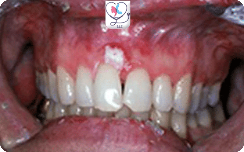 أعراض سرطان اللثة بالصور