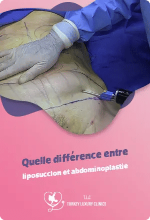 Quelle différence entre liposuccion et abdominoplastie ?featured image