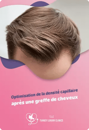 Optimisation de la densité capillaire après une greffe de cheveuxfeatured image