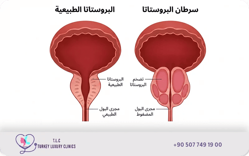 أعراض سرطان البروستاتا وعلاجه