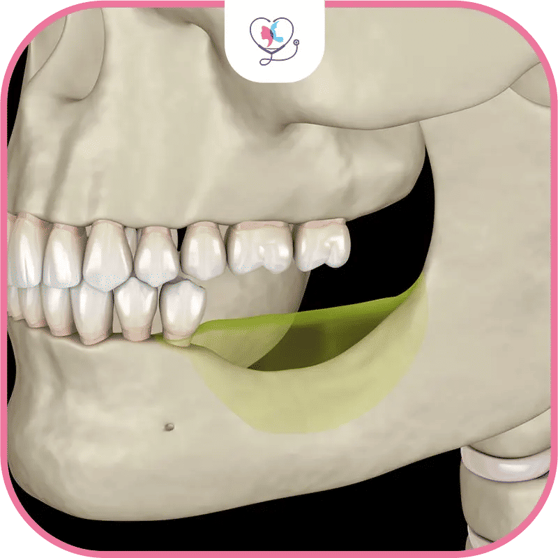 4. Synthetic (Alloplastic) Bone Grafts