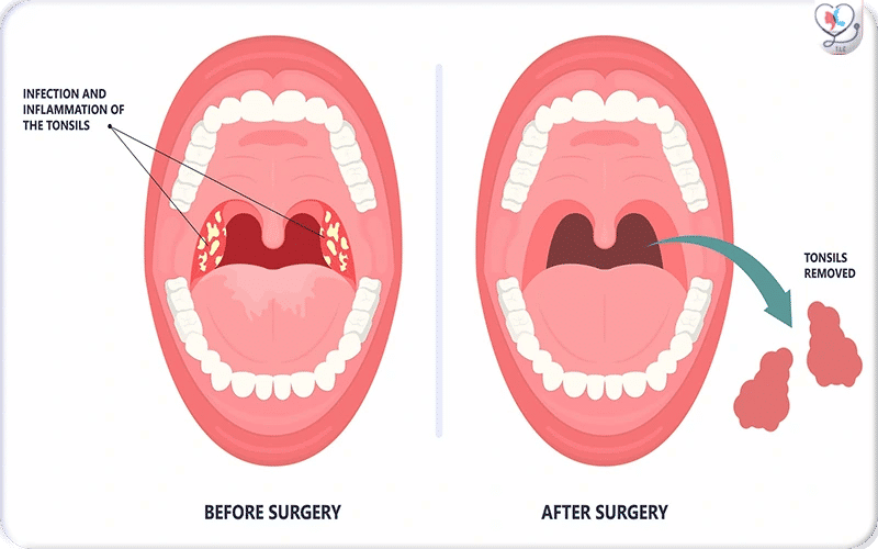 What Is a Tonsillectomy?