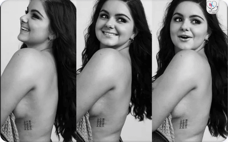 Ariel Winter Breast Reduction Scars