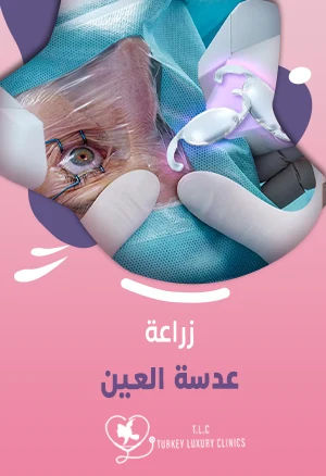 زراعة عدسة العين: الدليل الشامل مع الأسعار 2026
