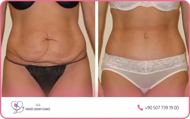 متى يعود البطن لطبيعته بعد الولادة القيصرية؟