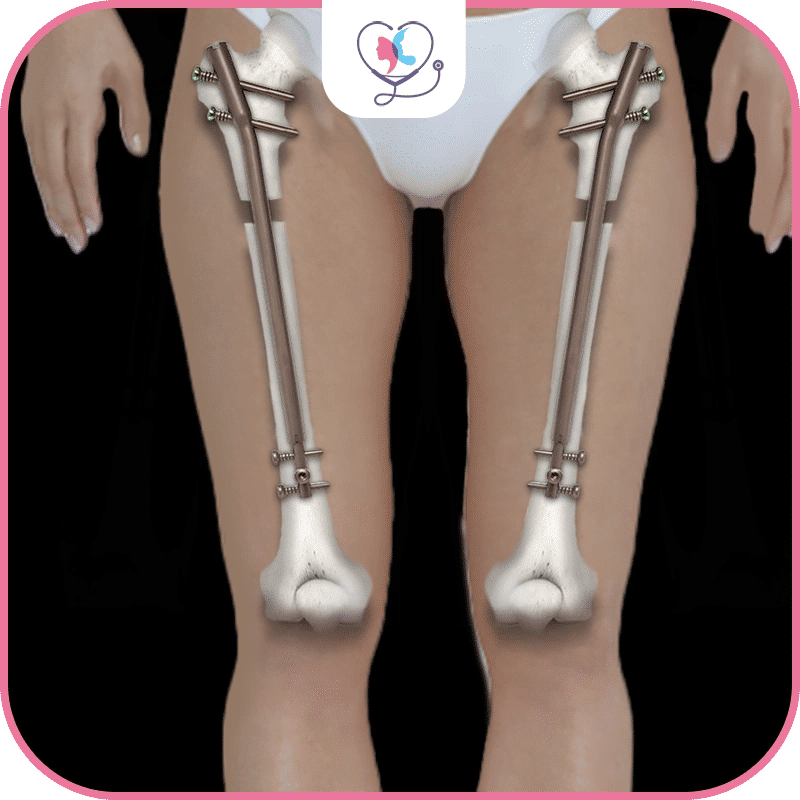 نبذة عن تطويل العظام باستخدام تقنية برسايس Percise 2