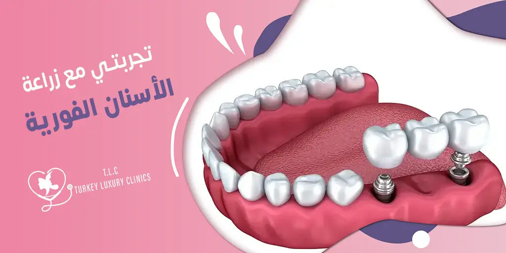 تجربتي مع زراعة الأسنان الفورية: نتائج حقيقية مع الصور