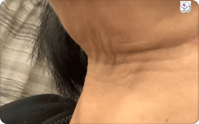 Bad Neck Lift Photos 3