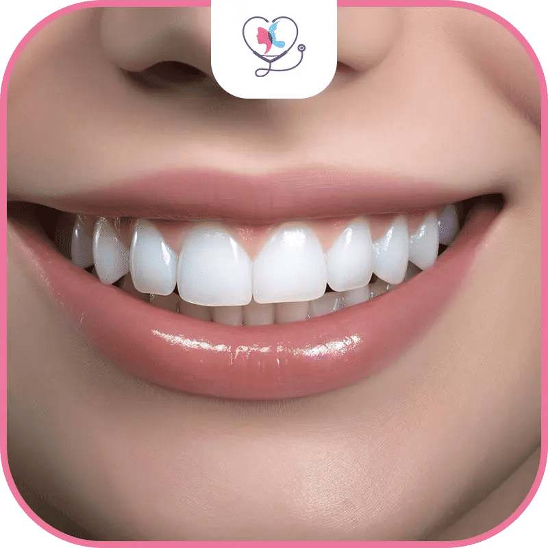 فوائد تركيب قشور الأسنان في تركيا