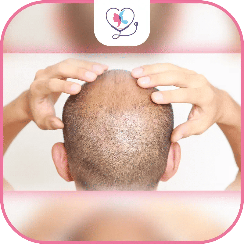 Recovery after Hair Transplant Revision Surgery