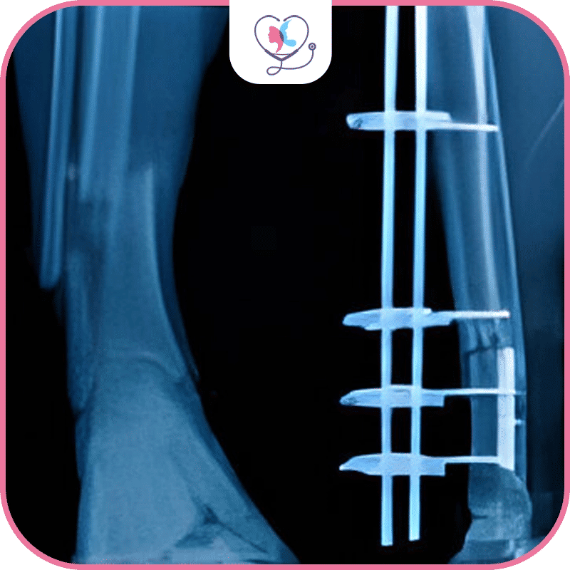 ما هي عملية زيادة الطول؟