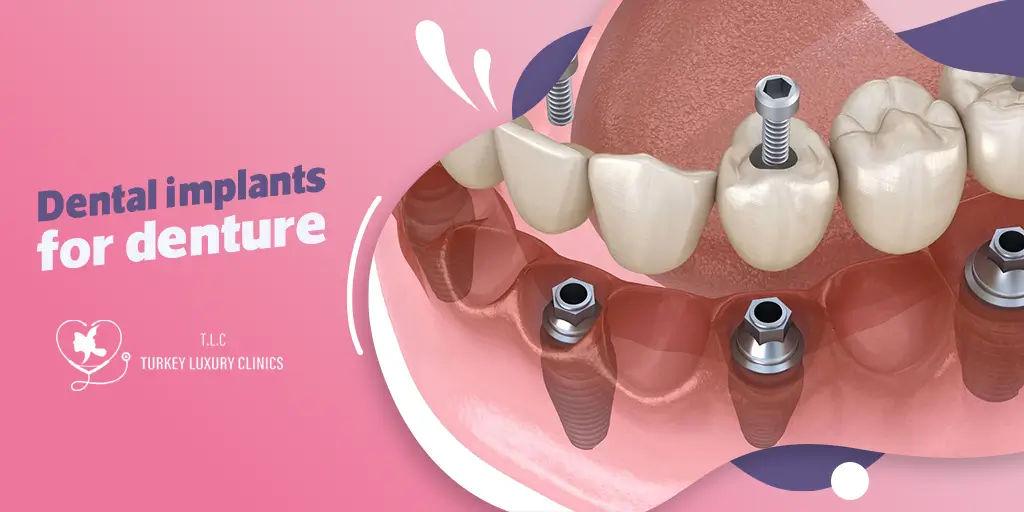 Dental Implants for Denture Stability: Enjoying a Secure and Comfortable Smile