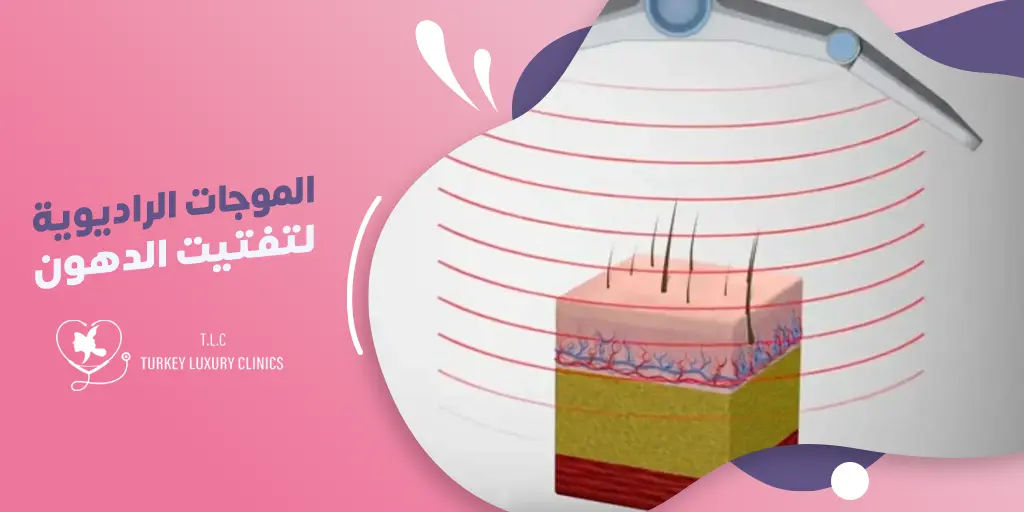الموجات الراديوية لتفتيت الدهون: كيف تعمل؟