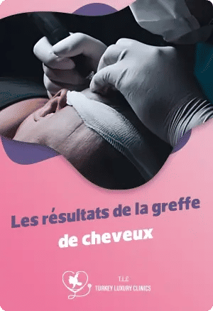 Les résultats de la greffe de cheveuxfeatured image
