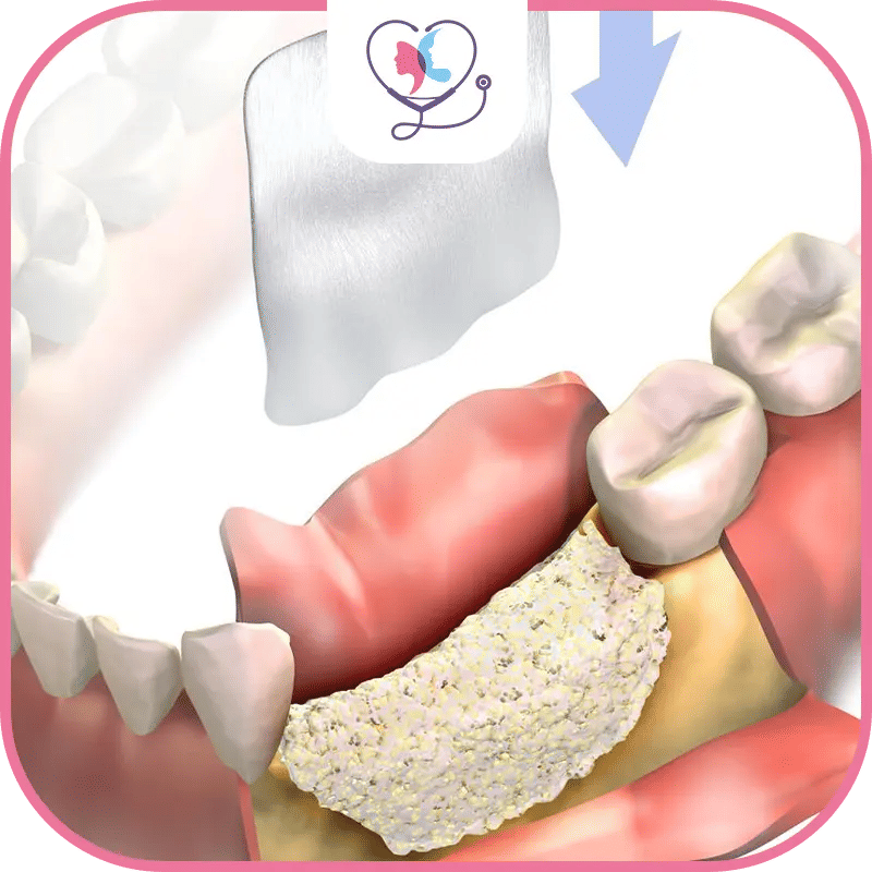 ما هي عملية زراعة عظم الفك؟