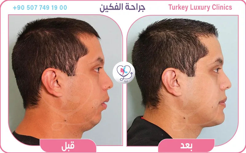 جراحة الفكين قبل وبعد