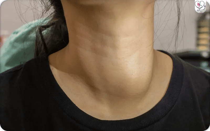 أعراض سرطان الغدة الدرقية عند النساء 