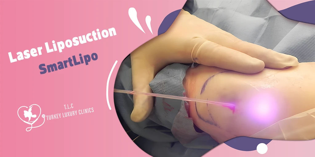 Laser Liposuction (SmartLipo): Results, Recovery & Areas