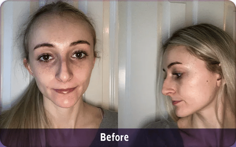 Rhinoplasty Recovery Photos Day by Day