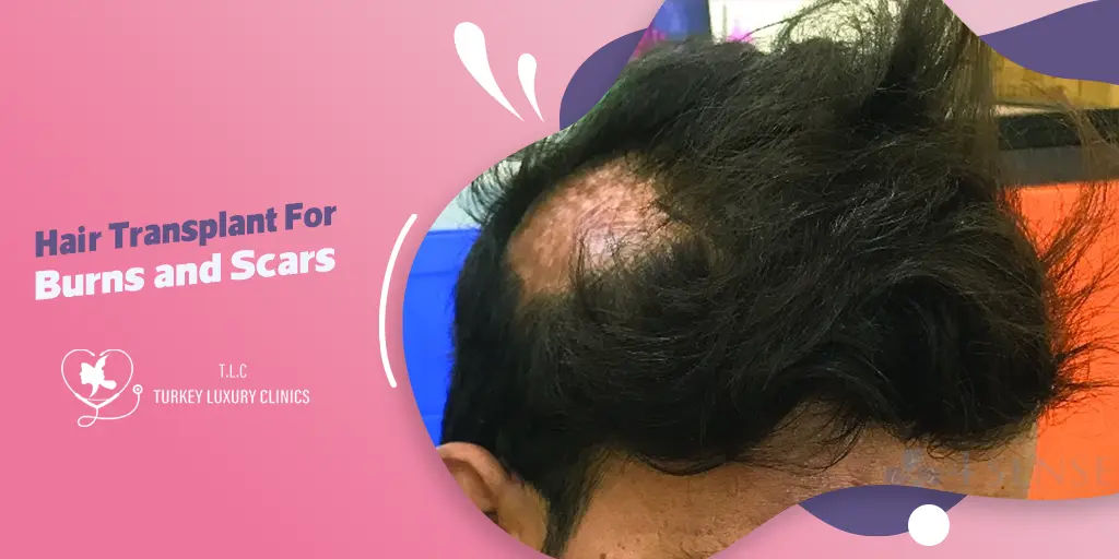 Hair Transplant For Burns and Scars