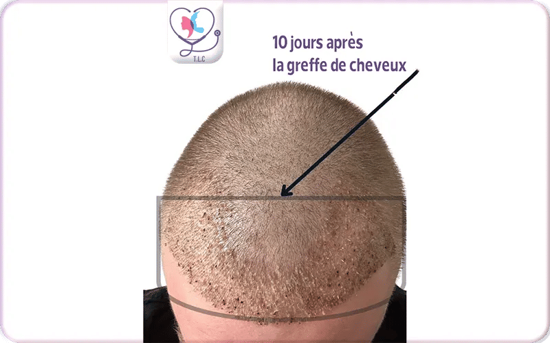 À quoi ressemble la zone transplantée 10 jours après-2
